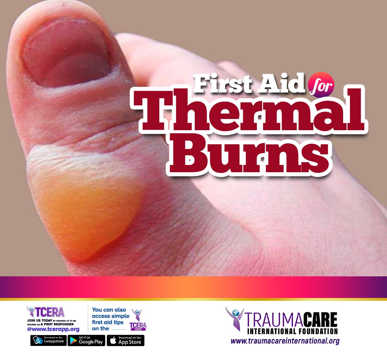 FIRST AID FOR THERMAL BURNS